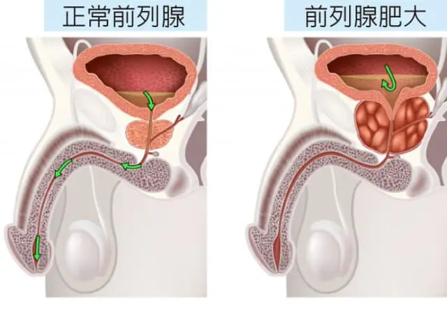 富联平台官方:拜登确诊恶性前列腺癌,他曾数次患癌,这次有生命危险吗?
